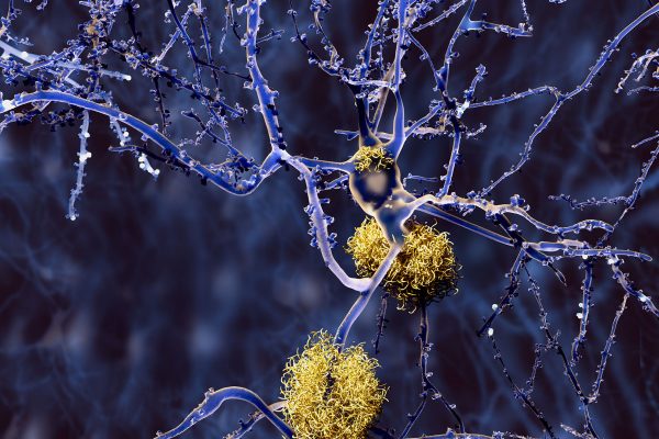 Alzheimer: Amyloid-Plaques an den Nervenzellen