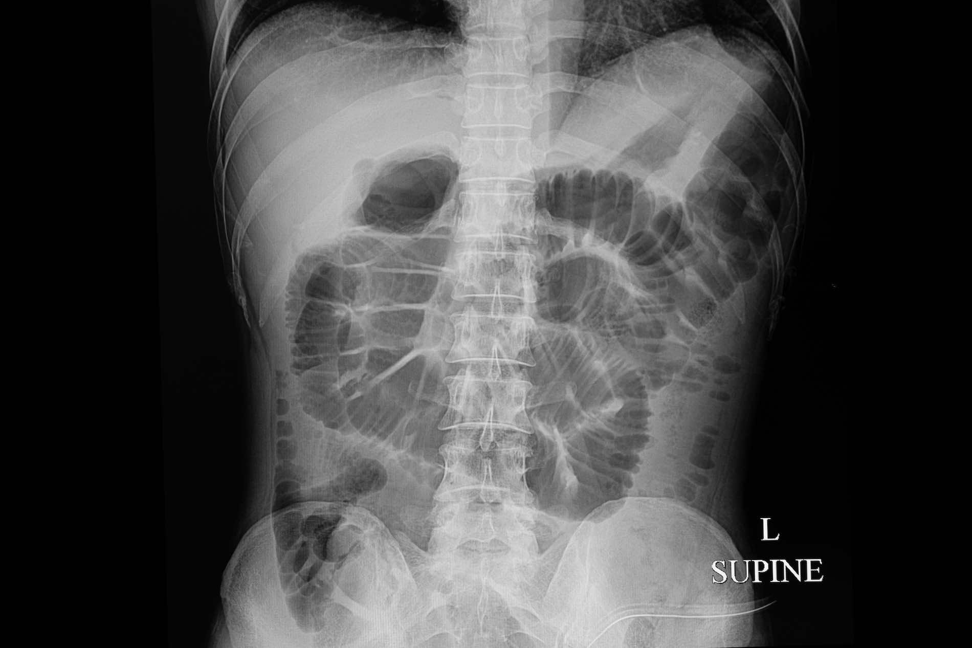 Röntgenbild eines mechanischen Darmverschlusses