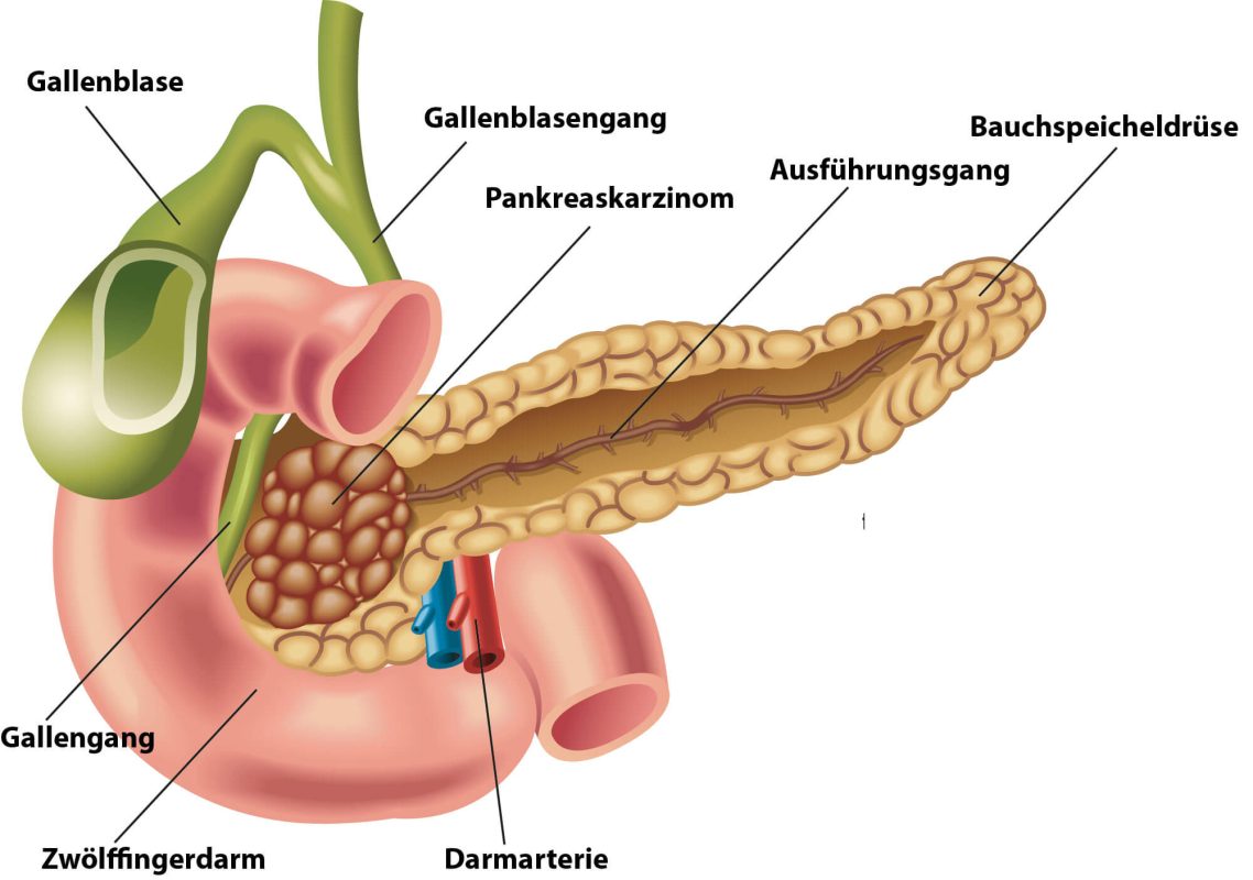 Bauchspeicheldrüsenkrebs - schematische Darstellung