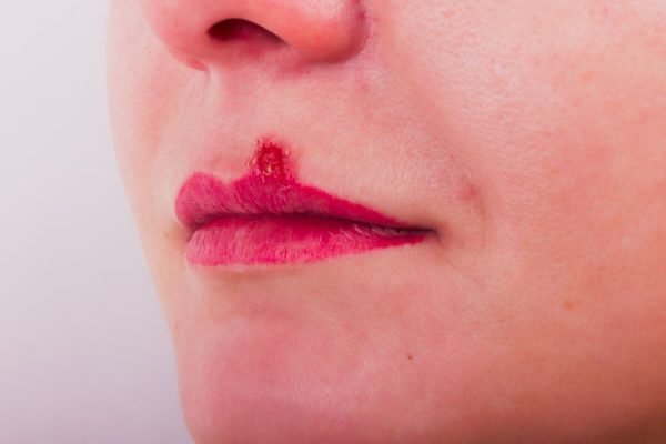 Herpes Simplex Ausbruch an der Lippe (Lippenherpes)