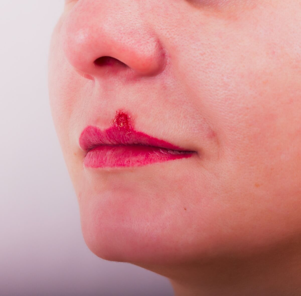 Herpes Simplex Ausbruch an der Lippe (Lippenherpes)