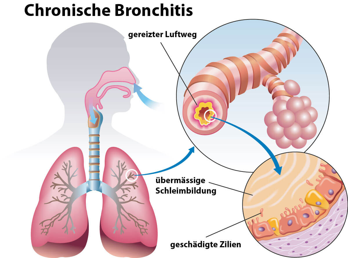 chronische Bronchitis