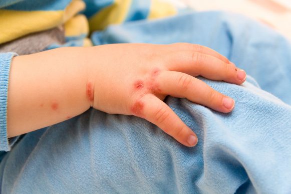Hand Fuss Mund Krankheit Bilder Symptome Ansteckung Behandlung Hausmittel