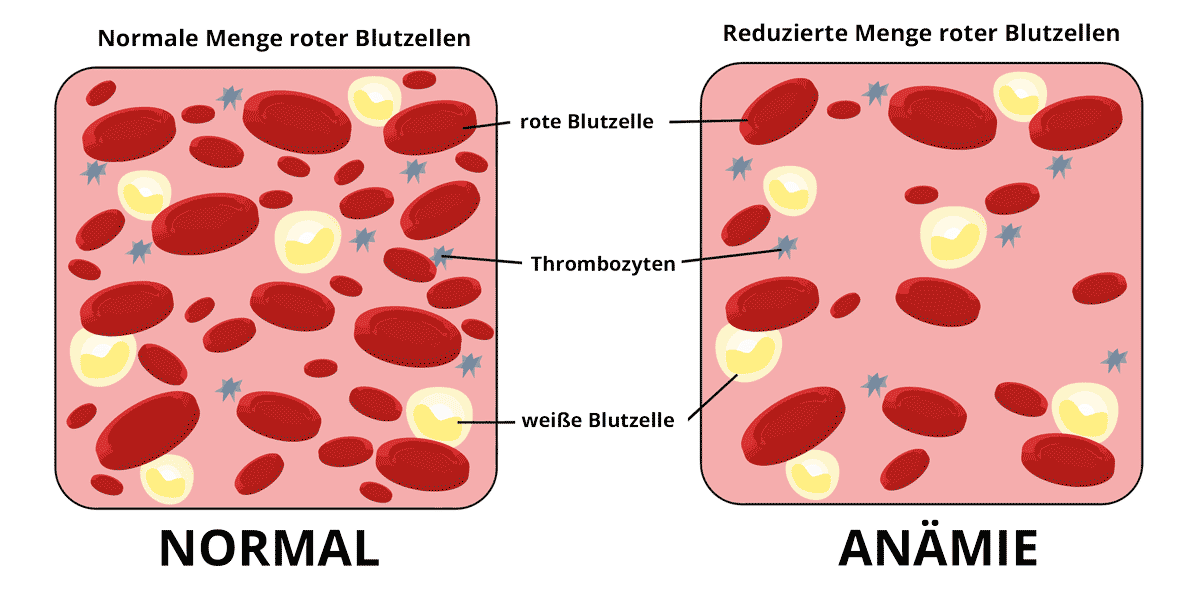 Anämie - schematische Darstellung