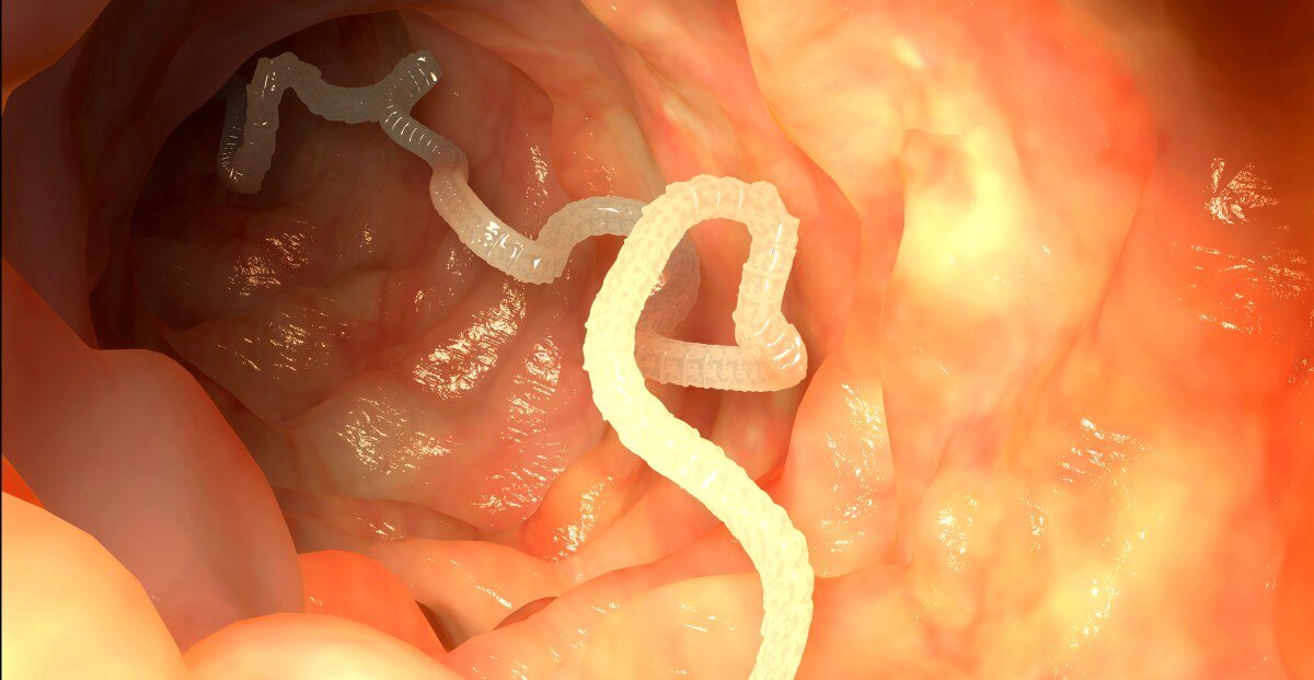 Bandwurm im menschlichen Verdauungssystem 