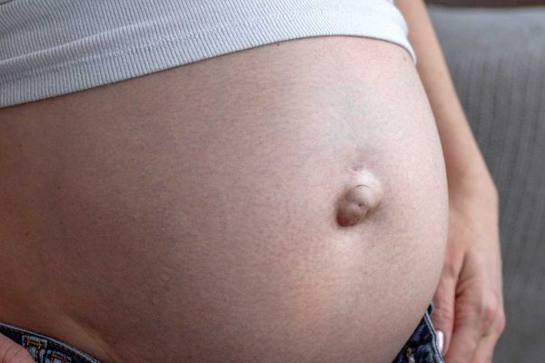 Schwangere mit Nabelbruch