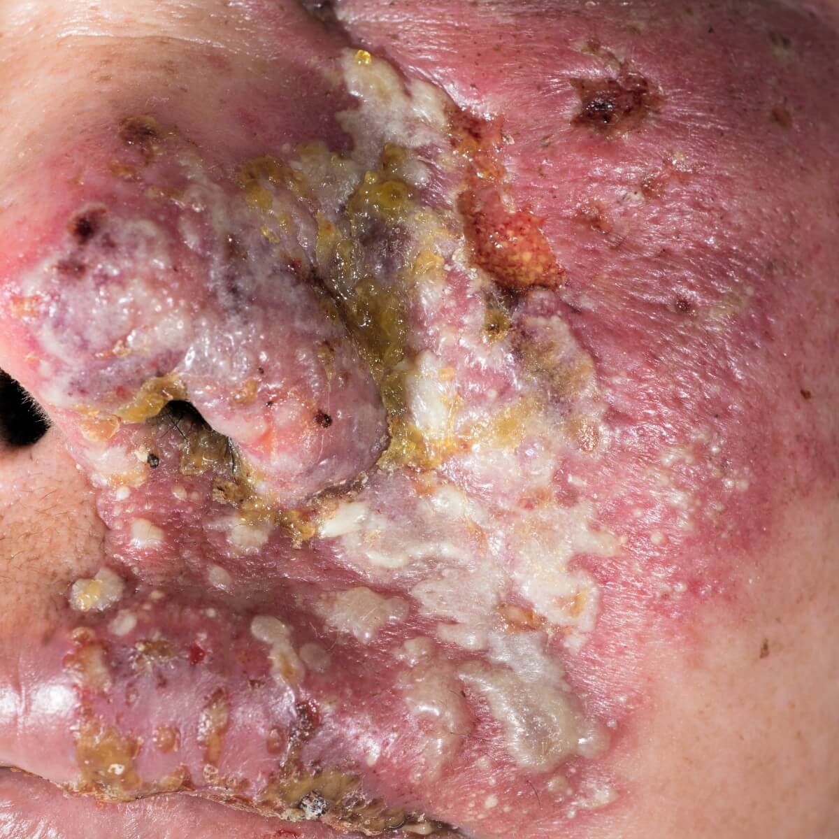 Gürtelrose / Herpes Zoster Infektion im Gesicht