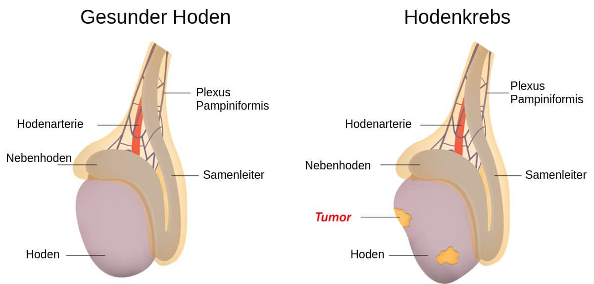 Hodenkrebs - Schematische Darstellung