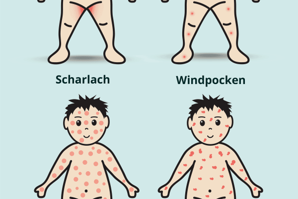 Kinderkrankheiten: Typischer Ausschlag bei Scharlach, Windpocken, Röteln und Masern