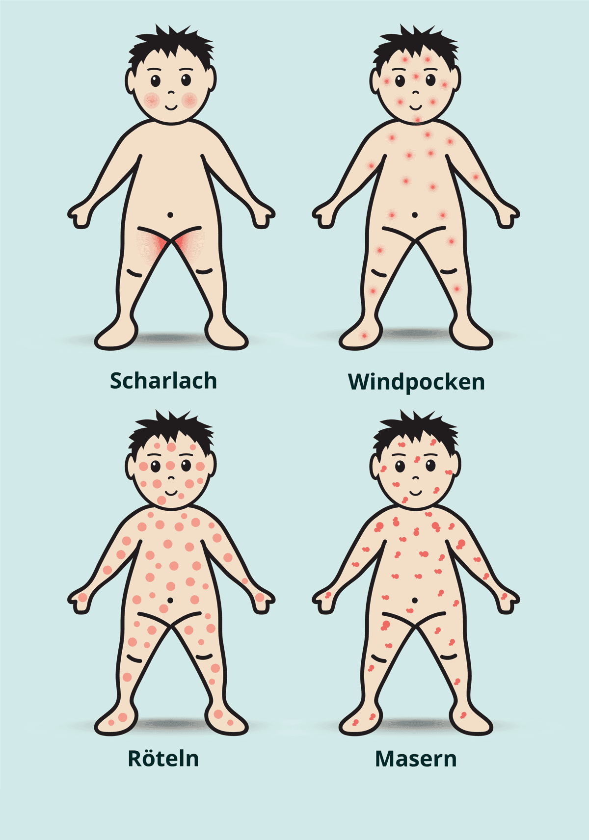 Kinderkrankheiten: Typischer Ausschlag bei Scharlach, Windpocken, Röteln und Masern