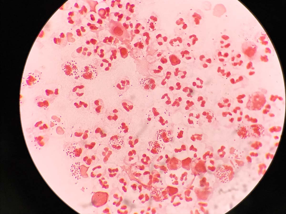 Syphilis-Erreger unter dem Mikroskop