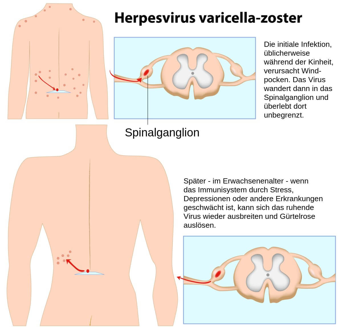 Varizella-Zoster-Virus