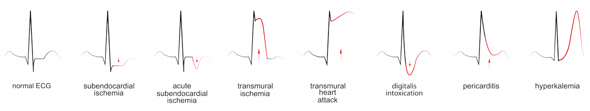 Herzinfarkt im EKG
