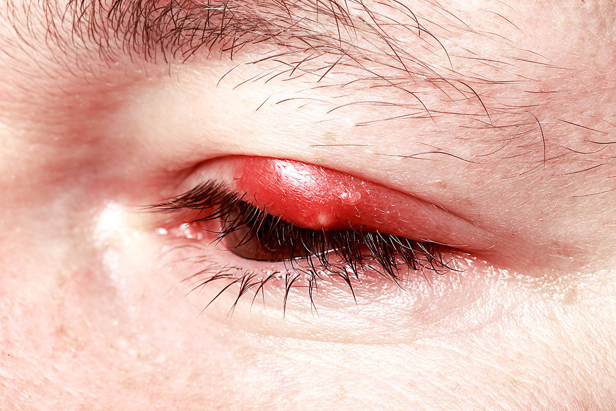 Entzündung des Augenlids